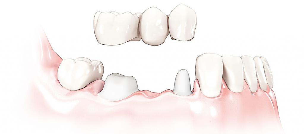 Восстановление зубного ряда