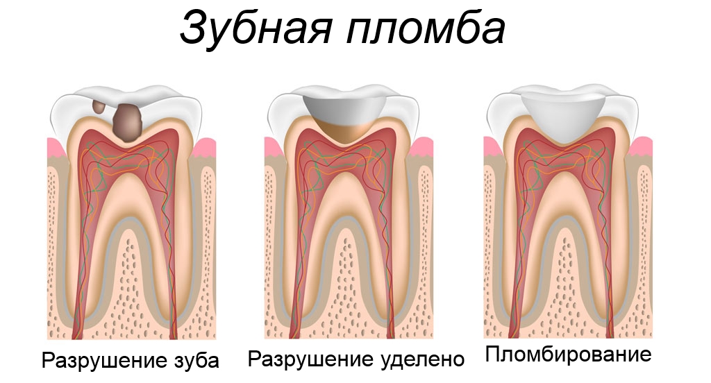 Зубная пломба