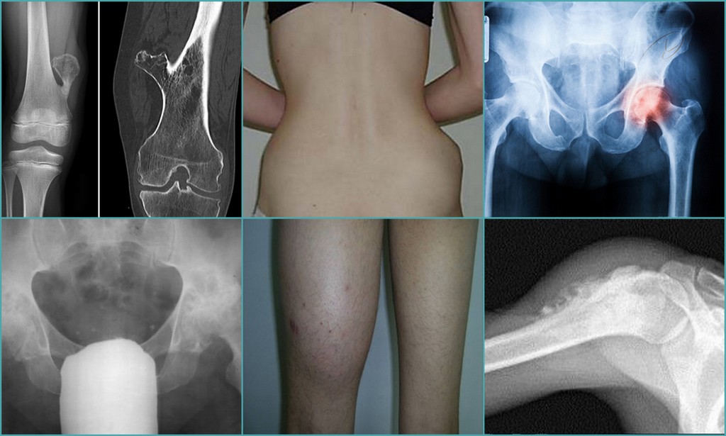 Операция тазобедренный кость. Экзостоз тазобедренного сустава. Остеосаркома коленного сустава рентген. Остеохондрома плечевой кости. Хондросаркома тазобедренного сустава на рентгене.