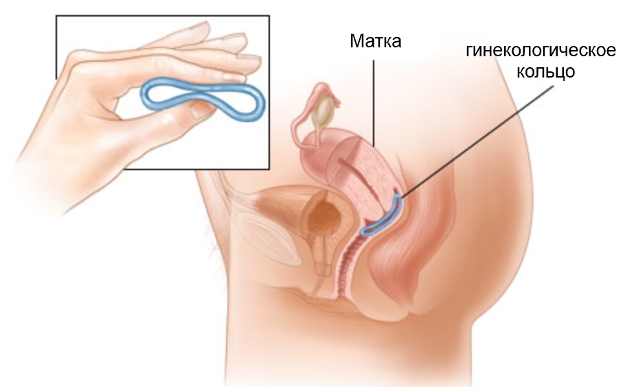 Кольцо во время беременности на шейку 19