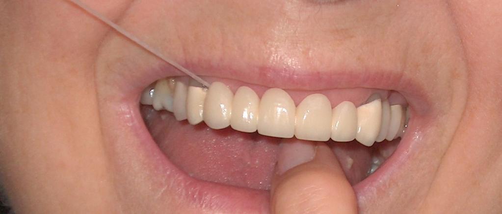 Восстановление переднего верхнего зубного ряда