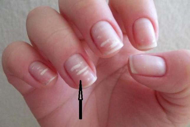 Как вылечить ногти от белых пятен thumbnail