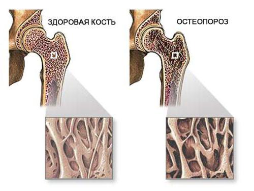 диффузный остеопороз костей