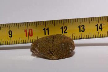 камни в почках лечение таблетками разбивающие камни
