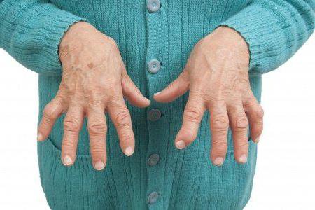 Деформация суставов пальцев рук лечение