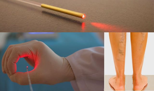 Варикоз на ногах лечение лазером отзывы последствия фото после выжигания thumbnail