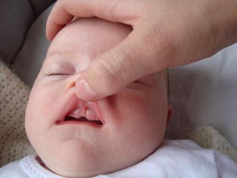 короткая уздечка верхней губы у ребенка