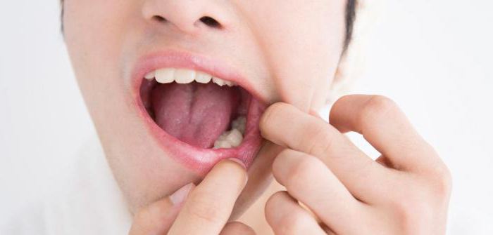 периостит нижней челюсти после удаления зуба