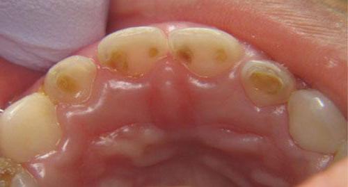 гиперплазия тканей зубов