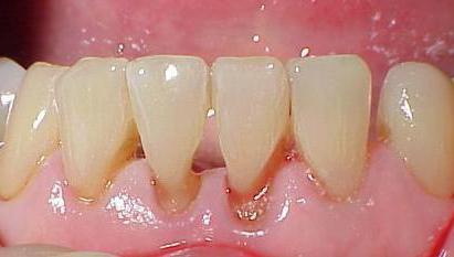 Лечение некариозное поражение твердых тканей зуба thumbnail