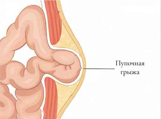 пупочная грыжа