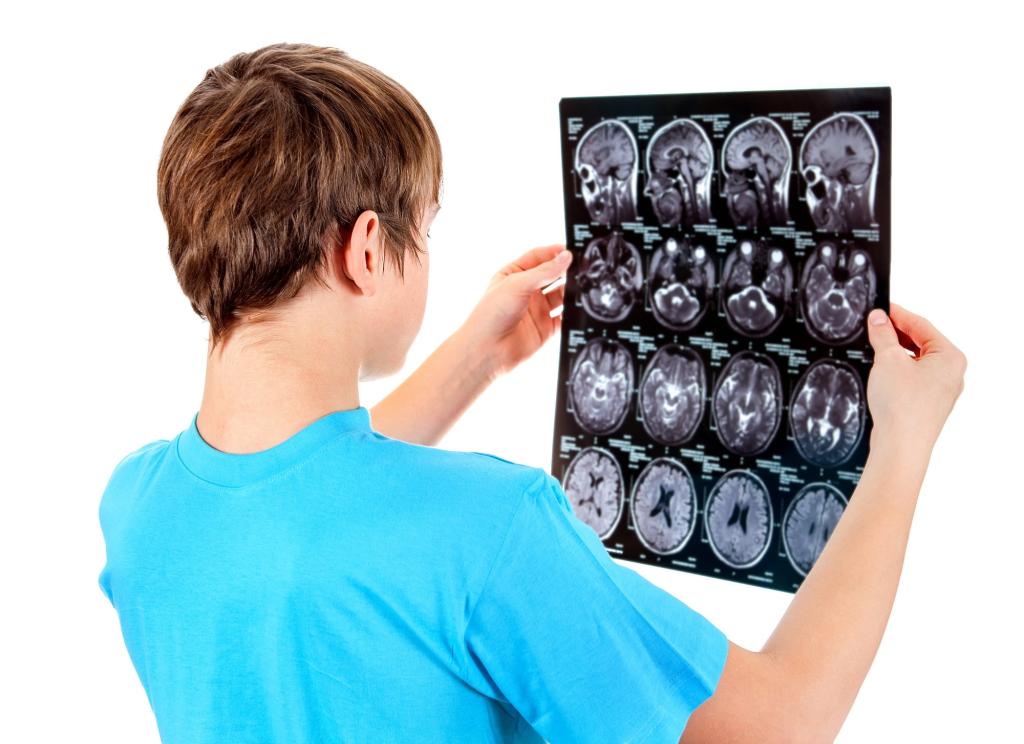 томография сотрясение мозга
