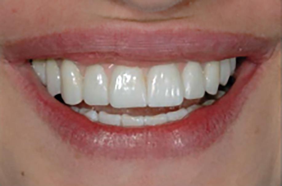Коронки на передние зубы фото