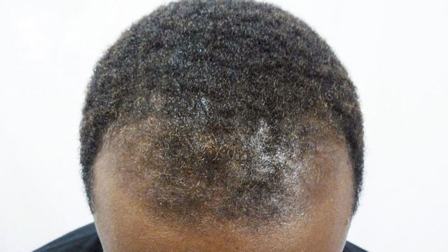 Восстановление волос у мужчин в домашних условиях 26