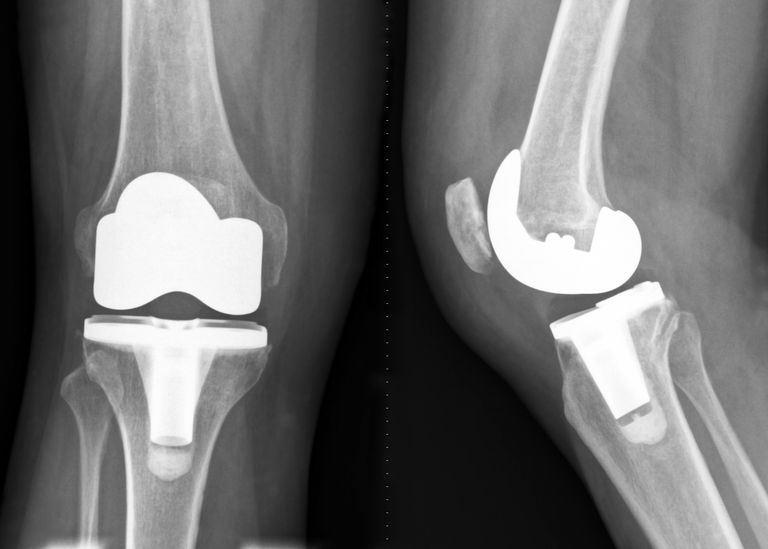период реабилитации после эндопротезирования коленного сустава