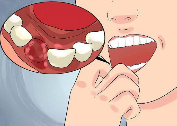 как заживает зуб после удаления