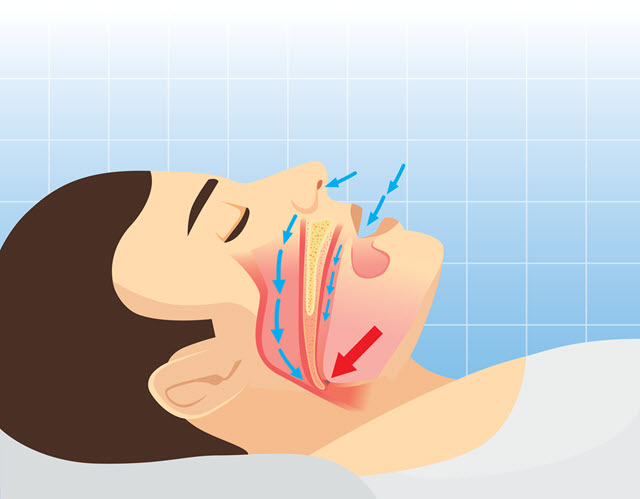 snoring mechanism