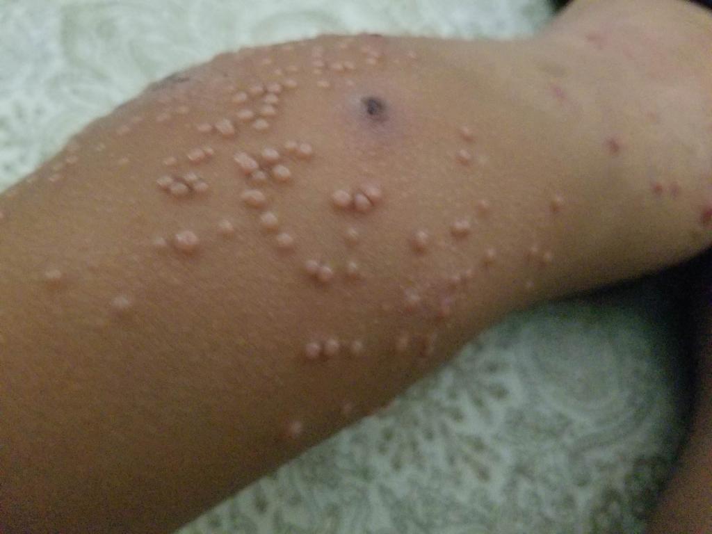 Е. Комаровский: Контагиозный моллюск у детей 11 фото Лечение и симптомы на коже