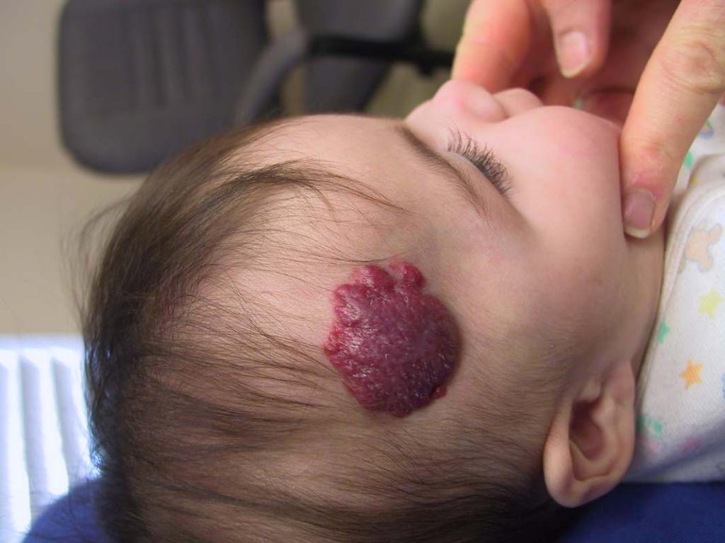 Выпуклая гемангиома на голове у ребенка