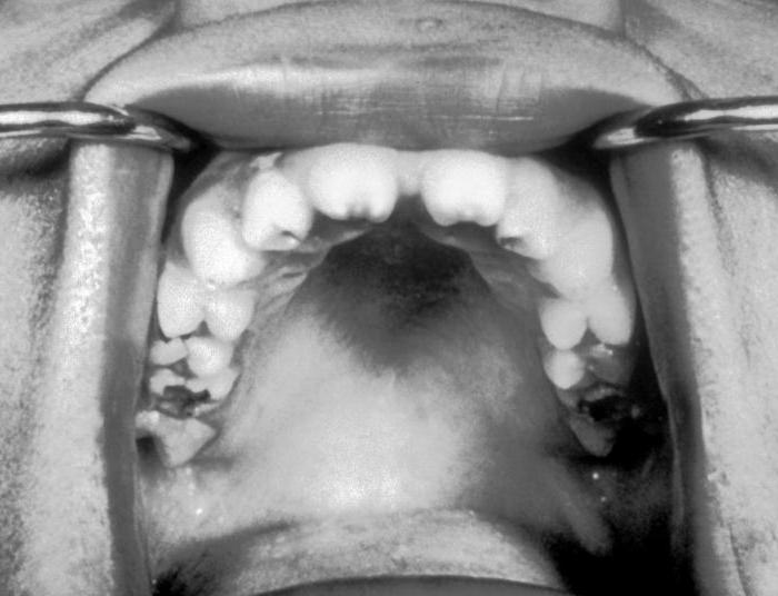 Зубы гетчинсона фурнье 18