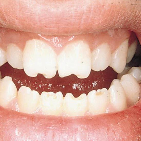 Зубы гетчинсона фурнье 21