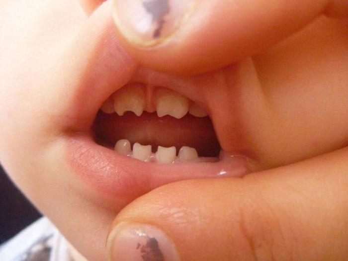 Зубы гетчинсона фурнье 17