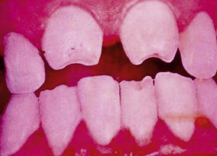 Зубы гетчинсона фурнье 22