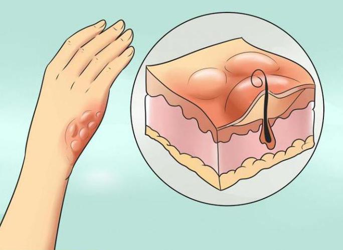 пузырь от ожога