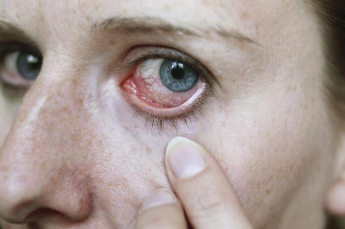 туберкулез глаз симптомы