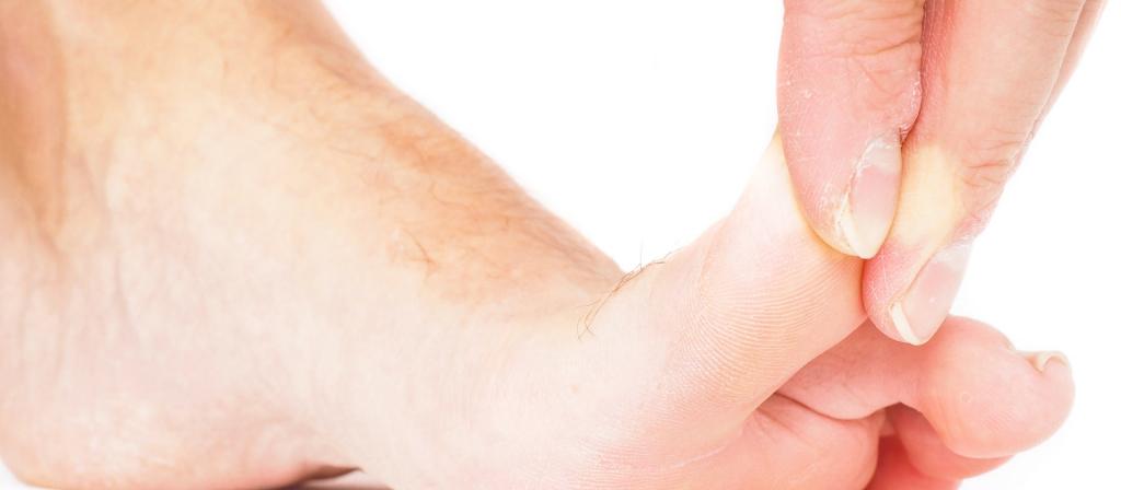 тилотическая экзема на пальцах ног