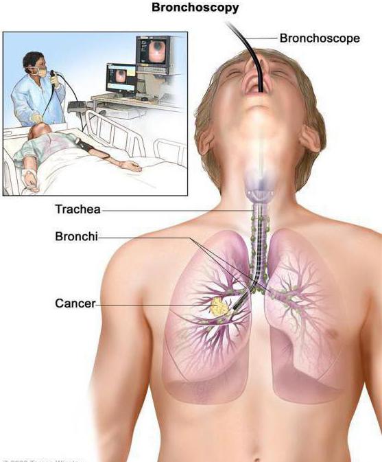 бронхоскопия легких что это такое