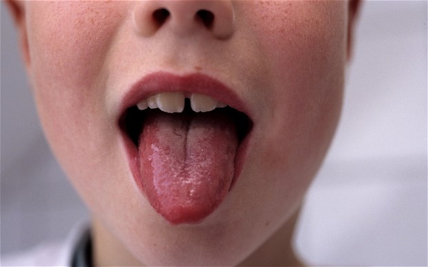 Красный язык у ребенка с пупырышками фото