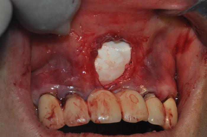 Костная пластика при имплантации зубов осложнения