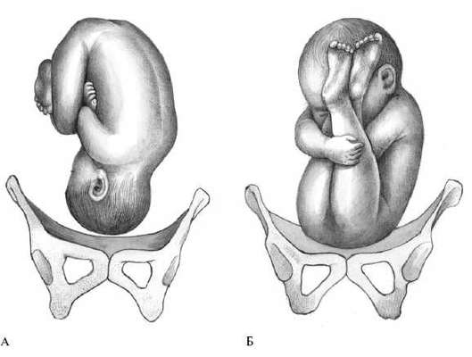 posterior asynclitism