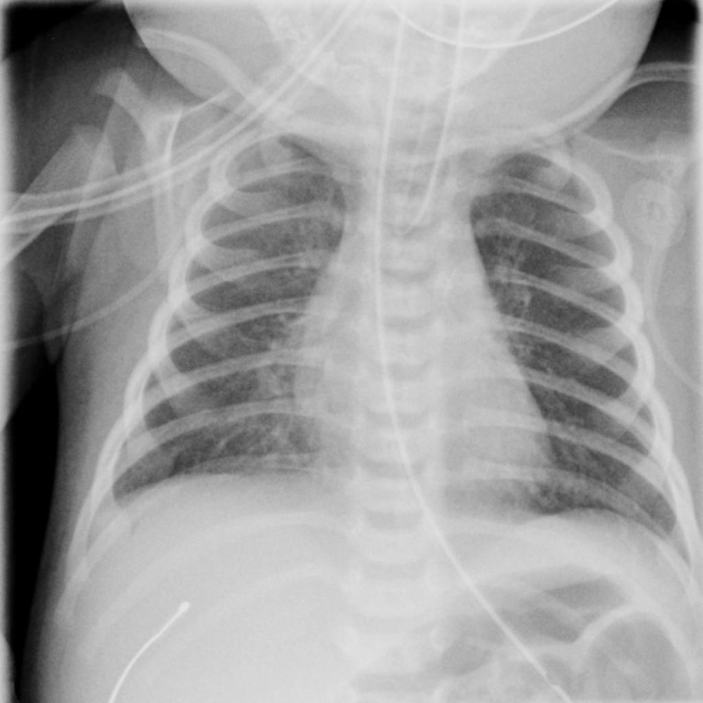 Рентген при пневмонии у детей фото