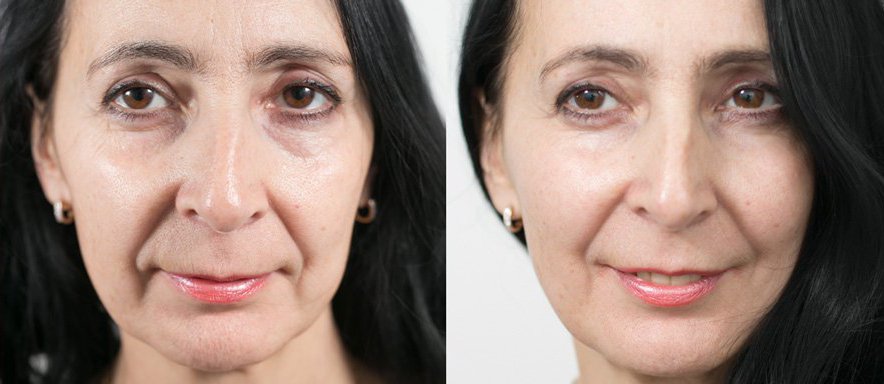 Биоармирование лица гиалуроновой кислотой фото до и после