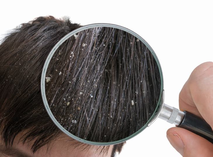 зуд кожи головы лечение народными средствами