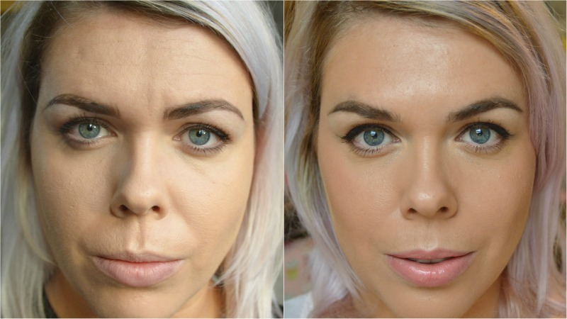 Ботокс глаз до и после в уголки фото