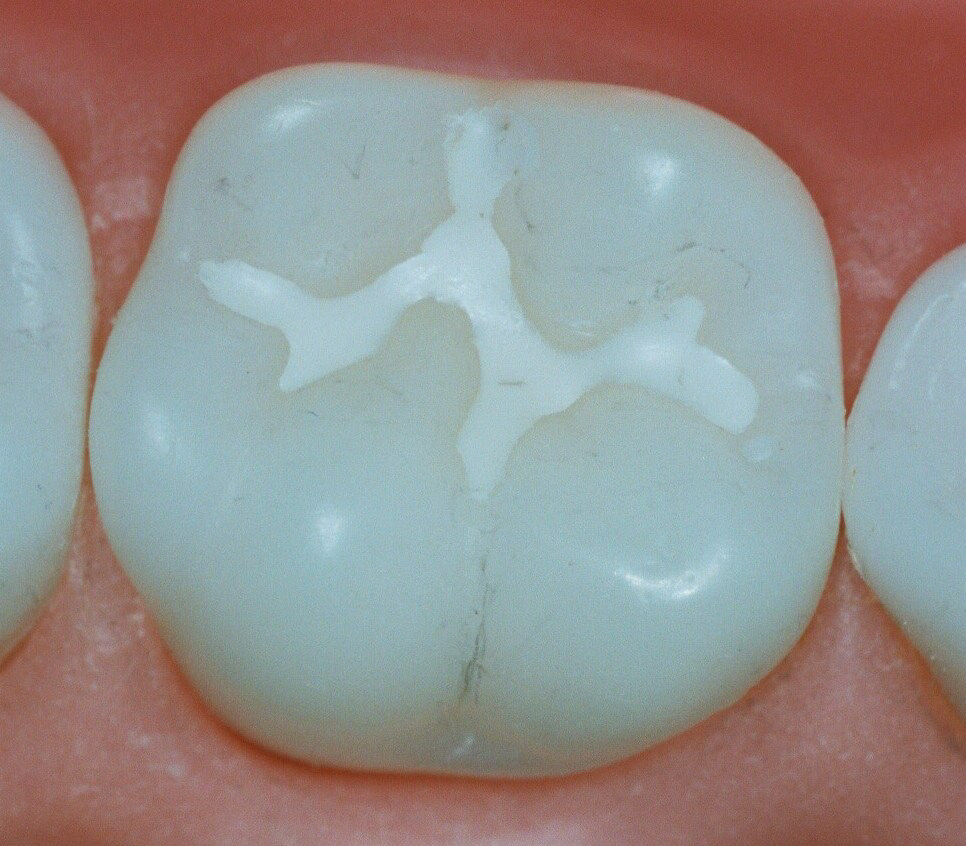герметизация фиссур зубов