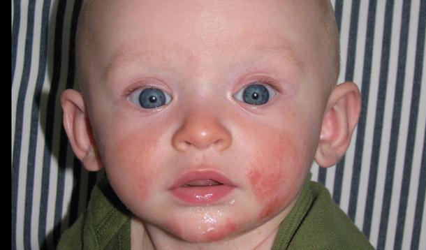 Аллергия у детей на животе фото
