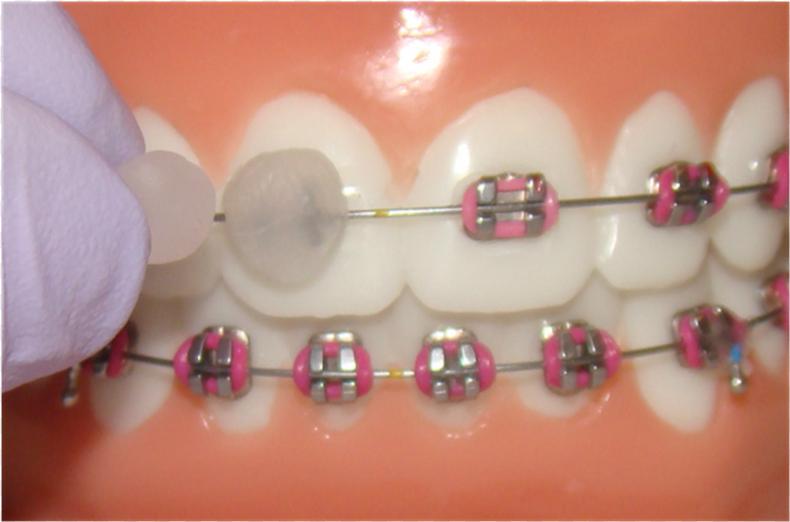 воск стоматологический для брекетов