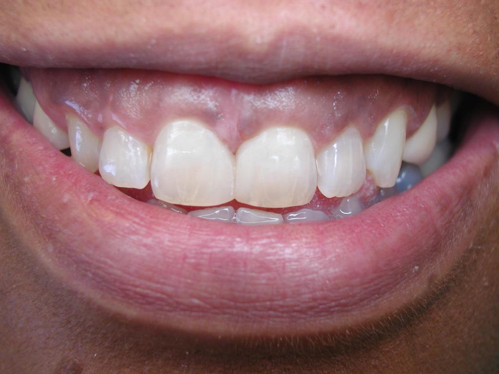 восстановления зуба с корня