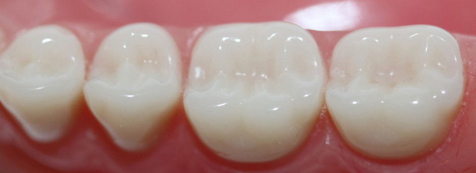 способы восстановления зуба если остался только корень