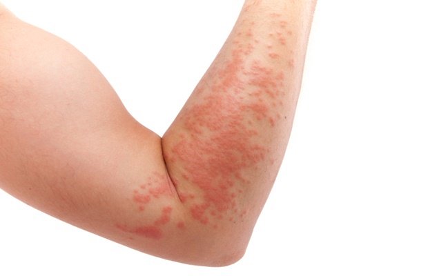 Аллергия на груши у взрослых и детей: симптомы, лечение