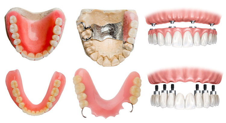 протезирование зубов полными съемными пластиночными протезами