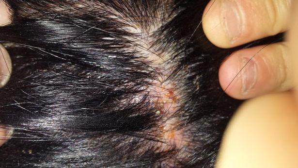 Аллергия на осветляющий порошок для волос что делать thumbnail