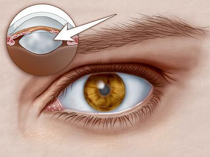 Аппарат для лечения катаракты глаз
