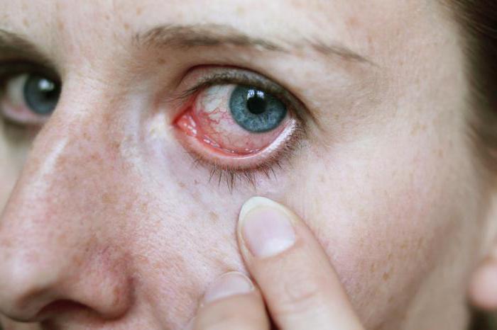 blepharitis symptoms and treatment photo