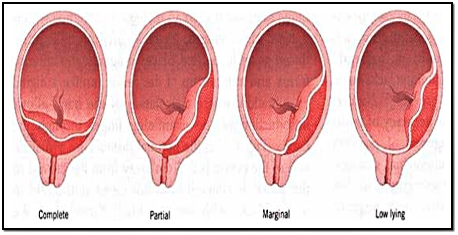 Зев закрыт при беременности. Центральное предлежание плаценты. Маргинальное предлежание плаценты. Край плаценты у внутреннего зева. Плацента перекрывает внутренний зев.