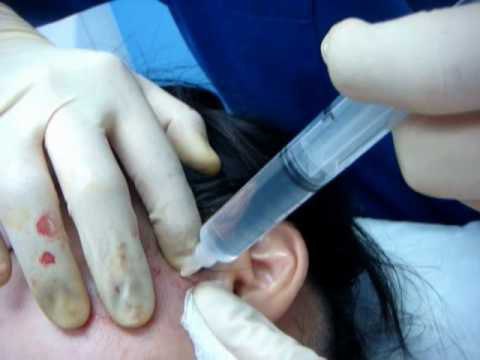 Воспаление челюстного сустава симптомы лечение